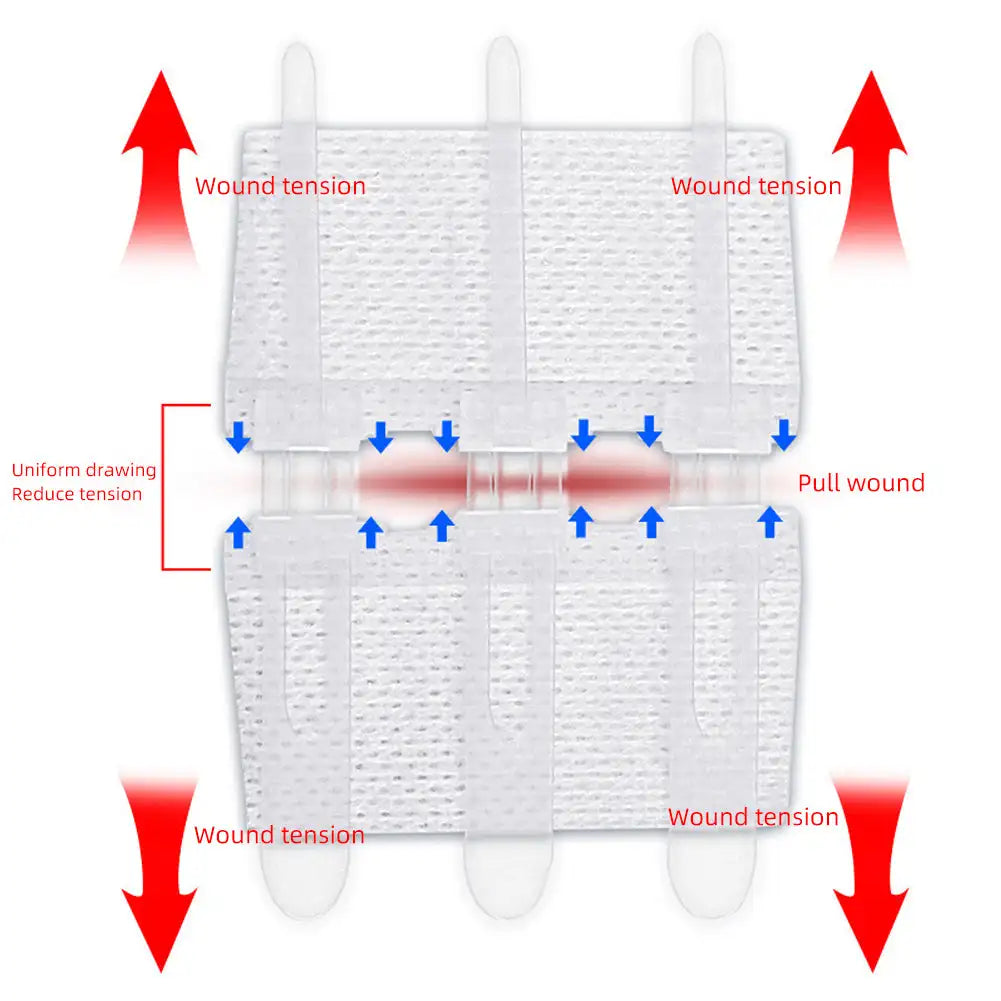 Emergency Laceration Closure Strips