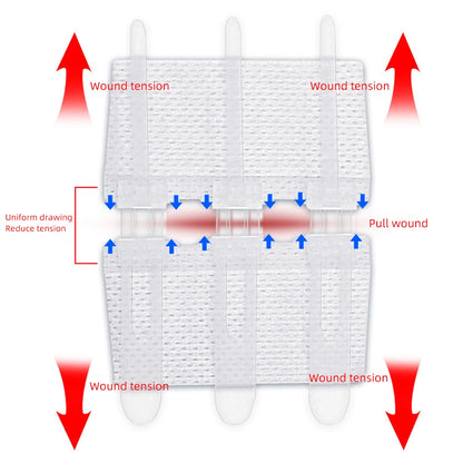 Emergency Laceration Closure Strips